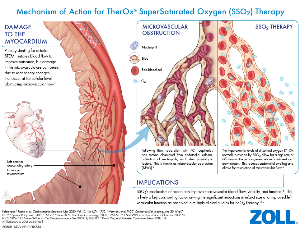 Mechanism of Action for TherOx SuperSaturated Oxygen (SSO2) Therapy